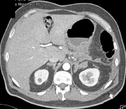 Collaterals Around Pancreas - CTisus CT Scan