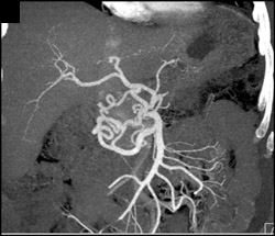 Collaterals Due to Median Arcuate Ligament Syndrome - CTisus CT Scan