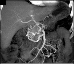 Nice Stenosis of Celiac Axis - CTisus CT Scan