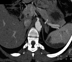 Prior Repair of Median Arcuate Ligament Syndrome- Splenic Infarct - CTisus CT Scan