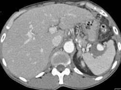 Splenic Artery Aneurysm - CTisus CT Scan