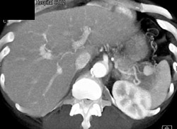 Splenic Artery Aneurysm - CTisus CT Scan