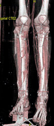 CTA Extremities - CTisus CT Scan