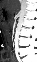 Superior Mesenteric Artery (SMA) Stenosis - CTisus CT Scan