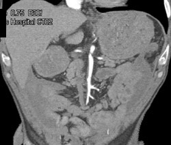 Narrowed SMA - Polyarterosis Nodosa - CTisus CT Scan