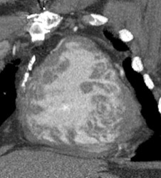 Thick Walled Left Ventricle - CTisus CT Scan