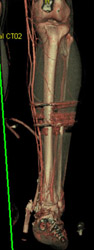 Pre-op Planning CTA - CTisus CT Scan