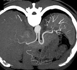 Hepatic and Splenic Artery Off the Aorta - CTisus CT Scan