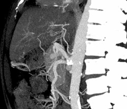 Common Origin SMA and Celiac Artery - CTisus CT Scan