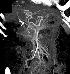 Replaced Right Hepatic Artery - CTisus CT Scan