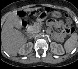 Small Caliber Aorta - CTisus CT Scan