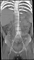 Small Caliber Aorta- Williams Syndrome - CTisus CT Scan