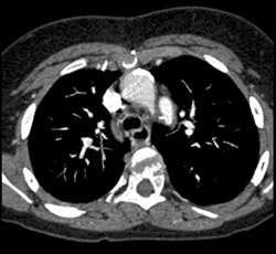 Prior Arch Aneurysm Repair - CTisus CT Scan