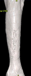 Post Bone Harvest CTA - CTisus CT Scan