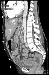 Narrowed Celiac and SMA Vasculitis - CTisus CT Scan