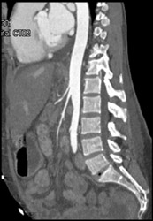 Narrowed Lumen Celiac and SMA - CTisus CT Scan