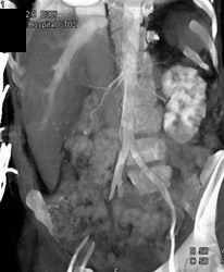 Vasculitis Kidney - CTisus CT Scan