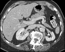 Left Renal Artery Stenosis With Decreased Renal Size - CTisus CT Scan