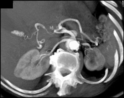 Left Renal Artery Stenosis - CTisus CT Scan