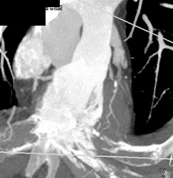 Diseased Coronary Artery - CTisus CT Scan