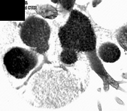 Endoluminal View - CTisus CT Scan