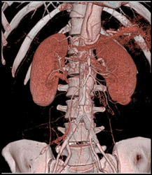 Iliac Grafts - CTisus CT Scan