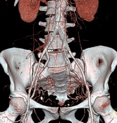 Nice Femoral Arteries - CTisus CT Scan