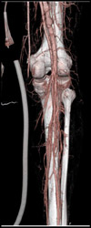 Normal Popliteal Arteries - CTisus CT Scan