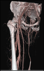 Normal Femoral Arteries on CTA - CTisus CT Scan