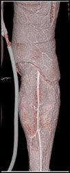 S/P Surgery for Necrotizing Fasciitis - CTisus CT Scan