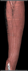 Normal Forearm CTA - CTisus CT Scan