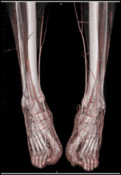 CTA of Feet (normal) - CTisus CT Scan