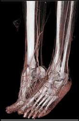 CTA of Feet - CTisus CT Scan