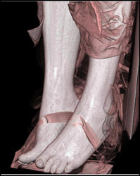 Soft Tissue and Muscle - CTisus CT Scan