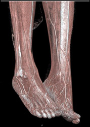 Normal Vessels - CTisus CT Scan