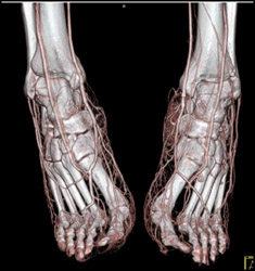 Normal Run Off Study - CTisus CT Scan