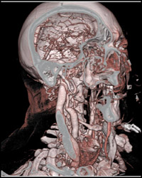 Normal Intracranial Circulation - CTisus CT Scan