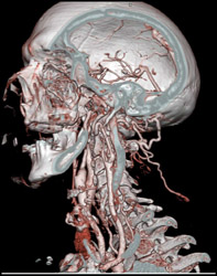 Carotid Stenosis - CTisus CT Scan