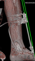 Ulcer With Wound - CTisus CT Scan