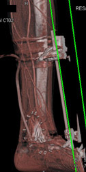 An External Fixation Device - CTisus CT Scan