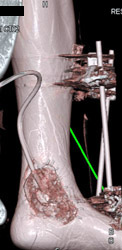 Ulcer With Packing - CTisus CT Scan