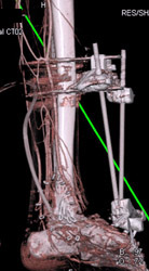 Normal CTA - CTisus CT Scan