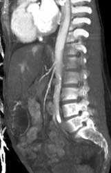 Narrowed Celiac and SMA - CTisus CT Scan