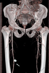 Occluded Left Femoral Artery - CTisus CT Scan