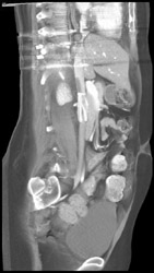 Clot in Inferior Vena Cava (IVC) - CTisus CT Scan