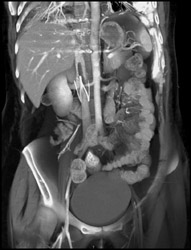 Clot Above Inferior Vena Cava (IVC) Filter - CTisus CT Scan