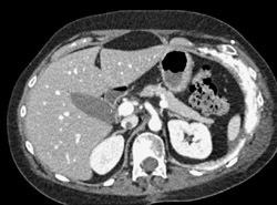 Inferior Vena Cava (IVC) Clot - CTisus CT Scan