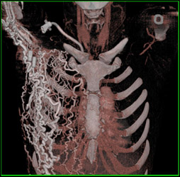 VRT of Chest Wall Collaterals - CTisus CT Scan