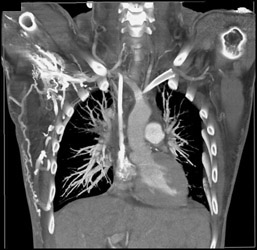 SVC Occlusion Due to Sarcoidosis - CTisus CT Scan