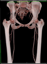 Normal Iliac Artery - CTisus CT Scan